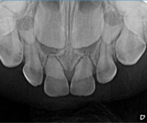Radiografia Periapical